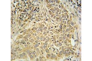 AHR antibody immunohistochemistry analysis in formalin fixed and paraffin embedded human lung carcinoma. (Aryl Hydrocarbon Receptor antibody  (AA 555-582))
