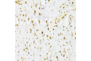 Immunohistochemistry of paraffin-embedded human gastric cancer using RBPJ Antibody (ABIN1876876) at dilution of 1:100 (40x lens). (RBPJ antibody)