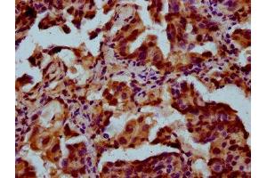 IHC image of ABIN7166751 diluted at 1:300 and staining in paraffin-embedded human lung cancer performed on a Leica BondTM system. (POU5F1B antibody  (AA 10-138))