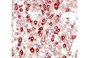 IHC testing of human hepatocarcinoma stained with SUMO2/3 antibody. (SUMO2/3 antibody  (AA 49-81))