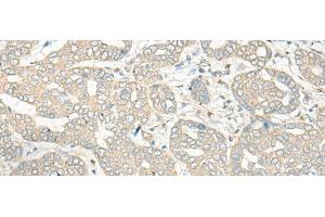 Immunohistochemistry of paraffin-embedded Human liver cancer tissue using HLA-DRB5 Polyclonal Antibody at dilution of 1:45(x200) (HLA-DRB5 antibody)