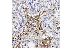 Immunohistochemistry of paraffin-embedded human lung cancer using GBP1 Rabbit mAb (ABIN7267549) at dilution of 1:100 (40x lens). (GBP1 antibody)