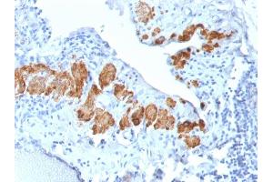 Formalin-fixed, paraffin-embedded human Breast Carcinoma stained with SM-MHC Recombinant Rabbit Monoclonal Antibody (MYH11/2303R). (Recombinant MYH11 antibody)