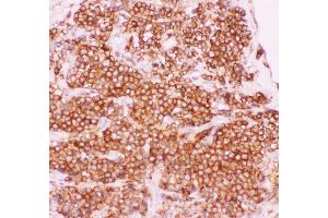 Anti-NFkB p105/P50 Picoband antibody,  IHC(P): Human Lung Cancer Tissue (NFKB1 antibody  (AA 1-360))