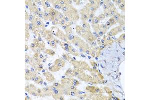 Immunohistochemistry of paraffin-embedded human liver injury using ABCB8 antibody at dilution of 1:100 (x40 lens).