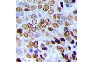 Immunohistochemical analysis of POLR3E staining in human prostate cancer formalin fixed paraffin embedded tissue section. (POLR3E antibody)