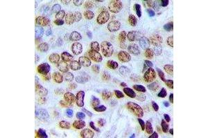 Immunohistochemical analysis of POLR3E staining in human prostate cancer formalin fixed paraffin embedded tissue section. (POLR3E antibody)