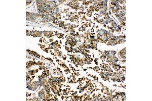 Anti-GRP78 BiP antibody, IHC(P) IHC(P): Human Lung Cancer Tissue