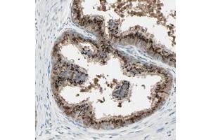 Immunohistochemical staining of human prostate with B4GALT1 polyclonal antibody  shows strong granular cytoplasmic positivity in glandular cells at 1:50-1:200 dilution. (B4GALT1 antibody)