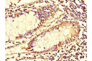 Immunohistochemistry of paraffin-embedded human colon cancer using ABIN7173699 at dilution of 1:100 (TUBG1 antibody  (AA 29-184))