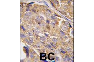 Formalin-fixed and paraffin-embedded human breast carcinoma tissue reacted with EIF4B-S422, which was peroxidase-conjugated to the secondary antibody, followed by DAB staining. (EIF4B antibody  (AA 400-429))