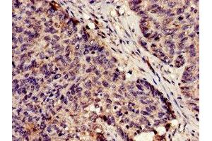 Immunohistochemistry analysis of human ovarian cancer using ABIN7163528 at dilution of 1:100 (SERPINA5 antibody  (AA 157-367))
