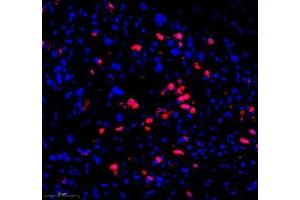 Immunofluorescence of paraffin embedded human gastric cancer using CD307 (ABIN7073931) at dilution of 1:1200 (300x lens) (FCRL5 antibody)