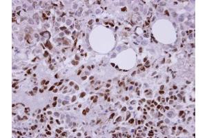IHC-P Image Immunohistochemical analysis of paraffin-embedded CL1-0 xenograft, using Laforin, antibody at 1:100 dilution. (EPM2A antibody  (C-Term))