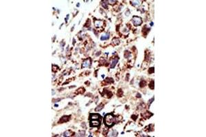 Formalin-fixed and paraffin-embedded human cancer tissue reacted with the primary antibody, which was peroxidase-conjugated to the secondary antibody, followed by AEC staining. (STAM antibody  (C-Term))