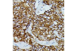 Immunohistochemistry of paraffin-embedded human mammary cancer using FCGR1B antibody (ABIN7267161) at dilution of 1:100 (40x lens).