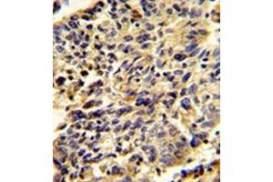 Immunohistochemistry analysis in formalin-fixed and paraffin-embedded human lung carcinoma reacted with Glypican-1 / GPC1Antibody (N-term) followed which was peroxidase-conjugated to the secondary antibody, followed by DAB staining.