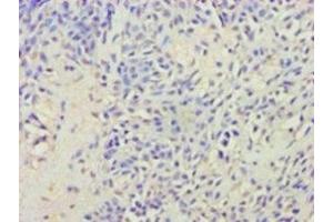 Immunohistochemistry of paraffin-embedded human breast cancer using ABIN7175416 at dilution of 1:100 (Vasopressin antibody  (AA 126-164))