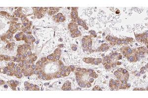 ABIN6272719 at 1/100 staining Human liver cancer tissue by IHC-P. (OR2B3 antibody  (Internal Region))