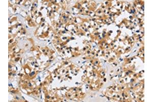 The image on the left is immunohistochemistry of paraffin-embedded Human thyroid cancer tissue using ABIN7191127(ITGA11 Antibody) at dilution 1/40, on the right is treated with synthetic peptide. (ITGA11 antibody)