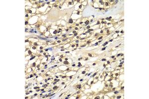 Immunohistochemistry of paraffin-embedded human kidney cancer using ZNF169 antibody (ABIN4905675) at dilution of 1:100 (40x lens). (ZNF169 antibody)