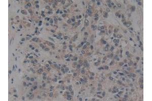 DAB staining on IHC-P; Samples: Human Prostate cancer Tissue (NUP153 antibody  (AA 1238-1468))
