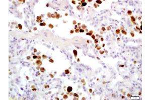 Formalin-fixed and paraffin embedded human lung carcinoma labeled with Anti-Granzyme B Polyclonal Antibody, Unconjugated (ABIN675354) at 1:200 followed by conjugation to the secondary antibody and DAB staining (GZMB antibody  (AA 21-130))