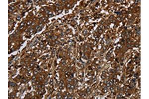 The image on the left is immunohistochemistry of paraffin-embedded Human liver cancer tissue using ABIN7191233(KLRF1 Antibody) at dilution 1/30, on the right is treated with synthetic peptide. (KLRF1 antibody)