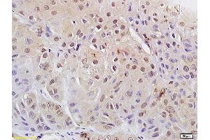 Formalin-fixed and paraffin embedded human laryngeal carcinoma labeled with Anti Phospho-cdc2 (Tyr15) Polyclonal Antibody, Unconjugated (ABIN684013) at 1:200 followed by conjugation to the secondary antibody and DAB staining (CDK1 antibody  (pTyr15))