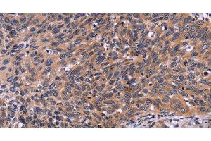 Immunohistochemistry of paraffin-embedded Human cervical cancer tissue using SPATA7 Polyclonal Antibody at dilution 1:30 (SPATA7 antibody)