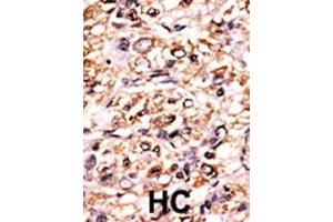 Formalin-fixed and paraffin-embedded human cancer tissue reacted with the primary antibody, which was peroxidase-conjugated to the secondary antibody, followed by DAB staining. (Separase antibody  (pSer1126))