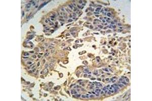 IHC analysis of FFPE human lung carcinoma tissue stained with RIPK3 antibody (RIPK3 antibody  (AA 489-518))