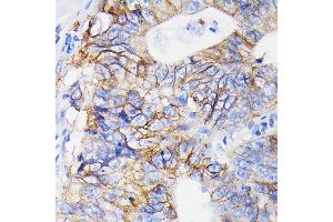 Immunohistochemistry of paraffin-embedded human colon carcinoma using Integrin alpha 2 (ITG/CD49b) (ITG/CD49b) Rabbit mAb  at dilution of 1:100 (40x lens). (ITGA2 antibody)