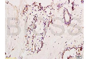 Formalin-fixed and paraffin embedded human breast carcinoma labeled with Anti-VCAM-1/CD106/L1CAM Polyclonal Antibody, Unconjugated (ABIN729838) at 1:200, followed by conjugation to the secondary antibody and DAB staining (VCAM1 antibody  (AA 651-739))