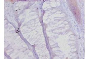 Immunohistochemistry of paraffin-embedded human colon cancer using ABIN7148231 at dilution of 1:20 (COL17A1 antibody  (AA 1253-1497))