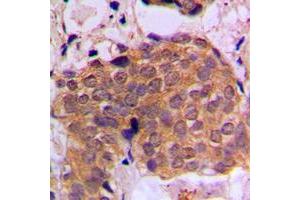 Immunohistochemical analysis of RAN staining in human breast cancer formalin fixed paraffin embedded tissue section.