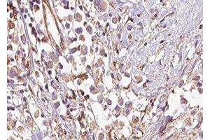 ABIN6277523 at 1/100 staining Human breast cancer tissue by IHC-P. (SGCE antibody  (Internal Region))