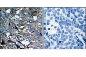 Immunohistochemistry analysis of paraffin-embedded human breast carcinoma, using ASK1 (Phospho-Ser83) Antibody. (ASK1 antibody  (pSer83))