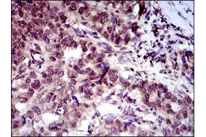 Immunohistochemical analysis of paraffin-embedded esophageal cancer tissues using CLGN mouse mAb with DAB staining.