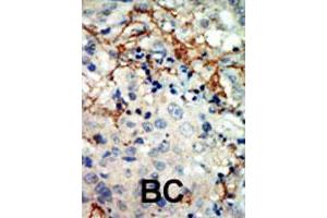 Formalin-fixed and paraffin-embedded human cancer tissue reacted with EPHA3 polyclonal antibody  , which was peroxidase-conjugated to the secondary antibody, followed by AEC staining. (EPH Receptor A3 antibody  (N-Term))