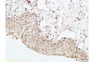 Formalin-fixed and paraffin embedded human cervical cancer labeled with Anti-PAR3 Polyclonal Antibody, Unconjugated  at 1:200 followed by conjugation to the secondary antibody and DAB staining (PARD3 antibody  (AA 1201-1356))