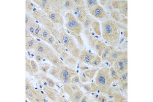 Immunohistochemistry of paraffin-embedded human liver cancer using BLVRB antibody. (BLVRB antibody  (AA 1-206))