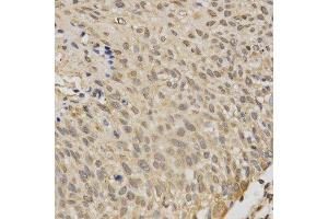 Immunohistochemistry of paraffin-embedded human esophageal cancer using STK11 antibody. (LKB1 antibody  (AA 134-433))