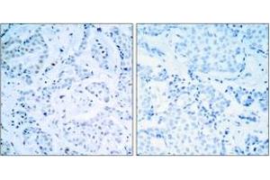 Immunohistochemistry analysis of paraffin-embedded human breast carcinoma tissue, using Estrogen Receptor-alpha (Ab-104) Antibody. (Estrogen Receptor alpha antibody  (AA 81-130))