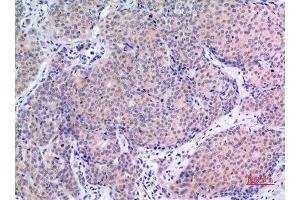 Immunohistochemistry (IHC) analysis of paraffin-embedded Human Mammary Cancer, antibody was diluted at 1:100.