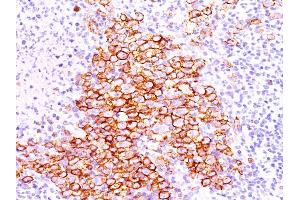 Formalin-fixed, paraffin-embedded human Hodgkin's lymphoma stained with CD30 Ab (CD30/412). (TNFRSF8 antibody)
