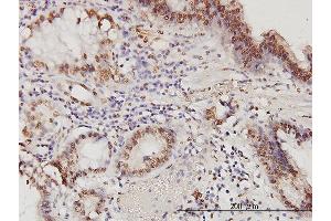 Immunoperoxidase of monoclonal antibody to PSME2 on formalin-fixed paraffin-embedded human stomach carcinoma. (PSME2 antibody  (AA 1-90))
