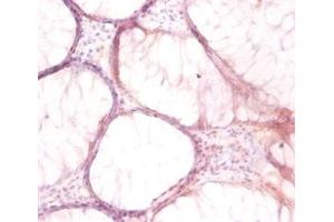 Immunohistochemistry of paraffin-embedded human colon cancer using ABIN7175262 at dilution of 1:50 (ATP6V1G1 antibody  (AA 2-118))
