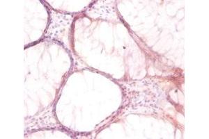 Immunohistochemistry of paraffin-embedded human colon cancer using ABIN7175262 at dilution of 1:50