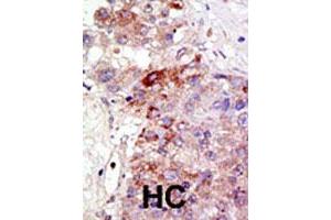 Formalin-fixed and paraffin-embedded human hepatocellular carcinoma tissue reacted with PIAS1 polyclonal antibody , which was peroxidase-conjugated to the secondary antibody, followed by DAB staining. (PIAS1 antibody  (AA 607-637))